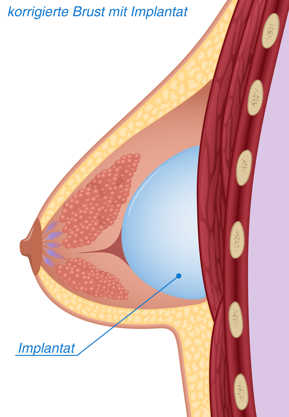 Implantat für tubuläre Brust